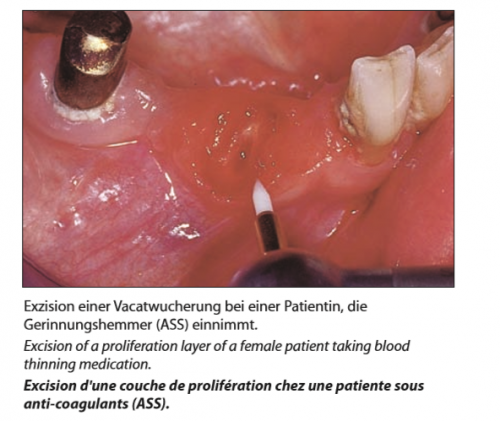 Trimmer Tissue (1)