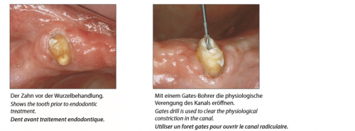 Endodontic